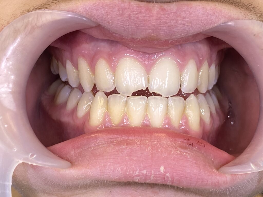 ricostruzione denti scheggiati
