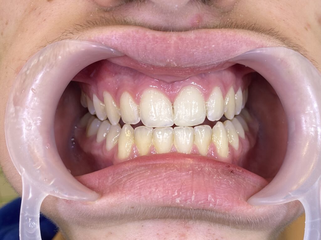 ricostruzione denti scheggiati
