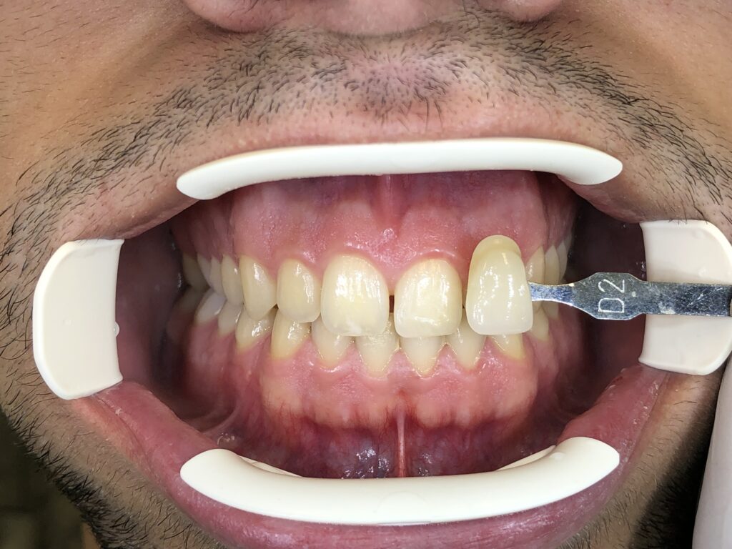 sbiancamento dentale