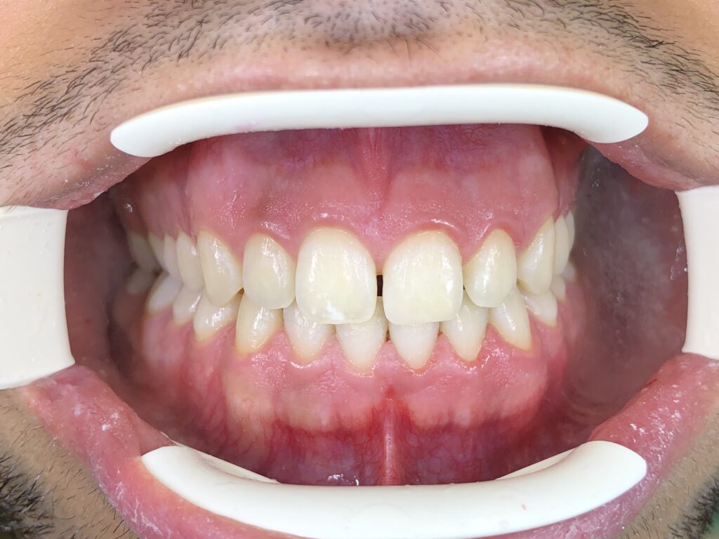 sbiancamento dentale